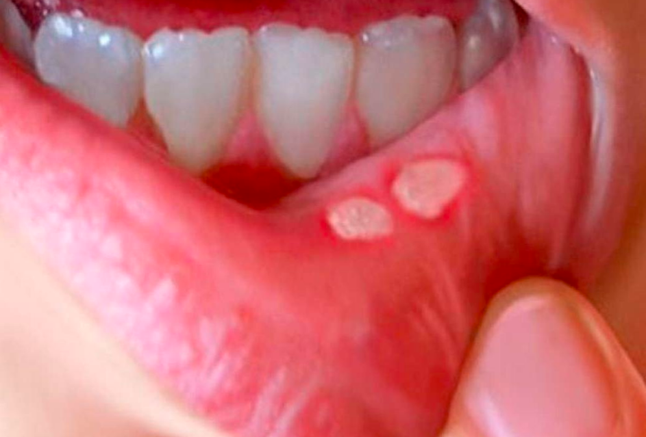 Mengatasi Sariawan bagi Pengguna Kawat Gigi